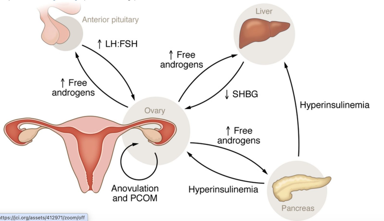 PCOS/PMOS pathophysiology diagram from Journal of Clinical Investigation showing feedback loops through pituitary, liver, pancreas, and ovary