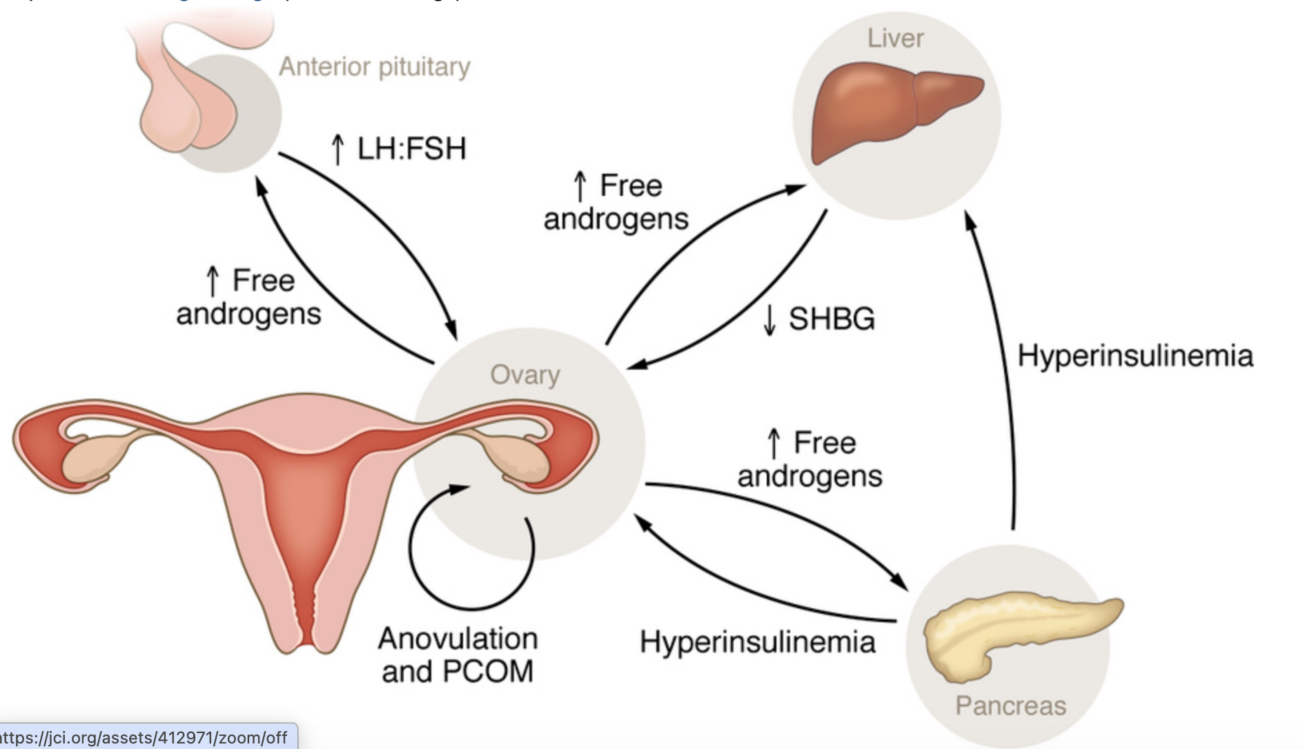 PCOS/PMOS pathophysiology diagram from Journal of Clinical Investigation showing feedback loops through pituitary, liver, pancreas, and ovary